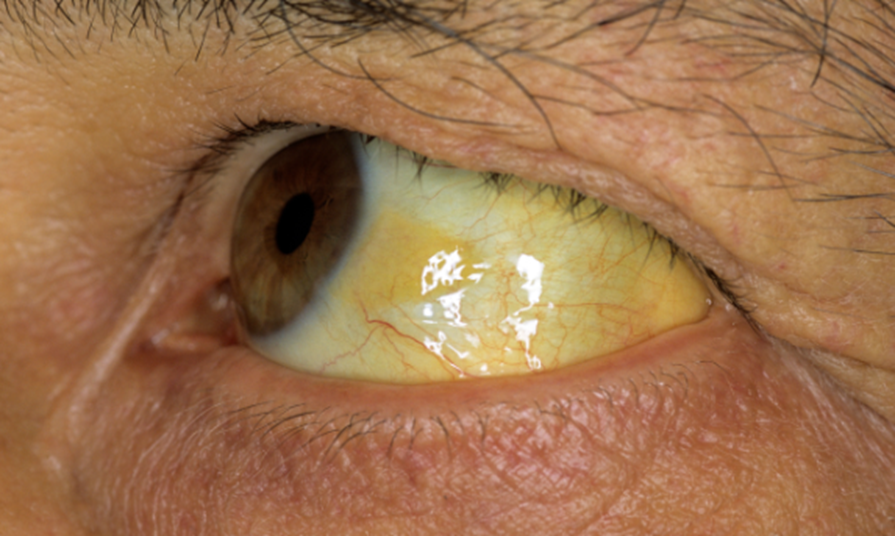 <ul><li><p class=""><strong>Definition</strong>: Yellow discoloration of <strong>skin, sclera, mucous membranes</strong></p></li><li><p class="">Caused by <strong>retention of bilirubin</strong> in tissues</p></li><li><p class=""><strong>Normal total bilirubin</strong>: <strong>1.0–1.5 mg/dL</strong></p></li><li><p class=""><strong>Visible jaundice</strong> not seen until levels reach <strong>3.0–5.0 mg/dL</strong></p><p></p></li></ul><p></p>