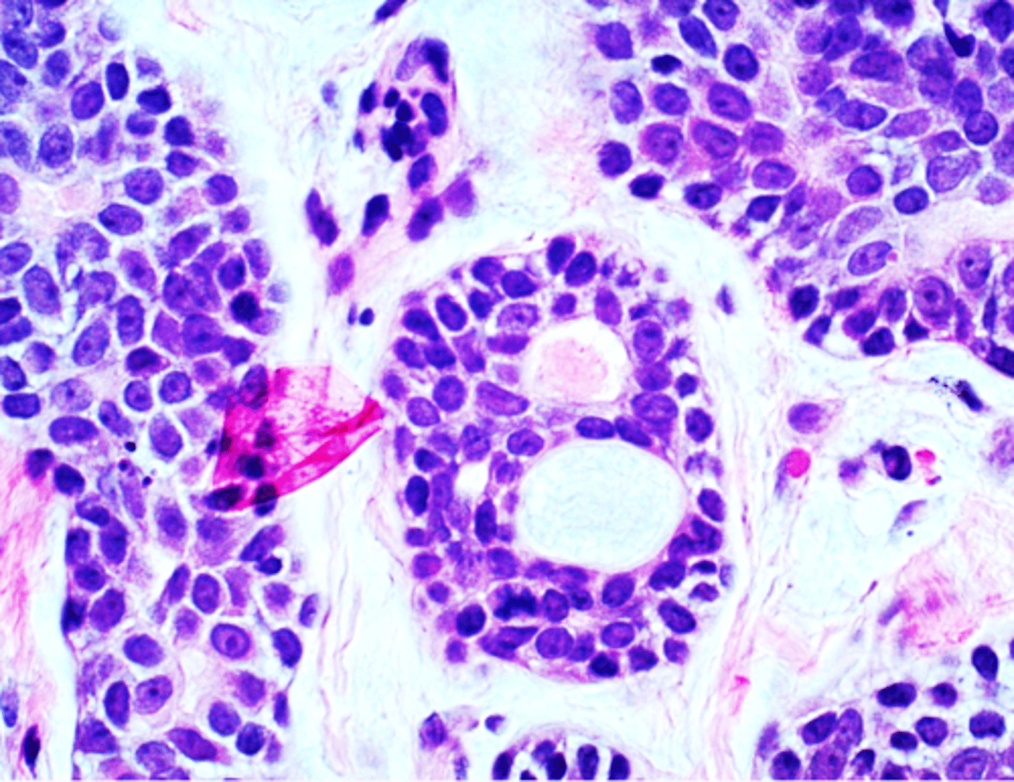 <p>• Swiss Cheese pattern</p><p>▫ Islands with a</p><p>cribriform pattern</p><p>▫ Myoepithelial and ductal cells are present</p><p>▫ Perineural and perivascular invasion</p>