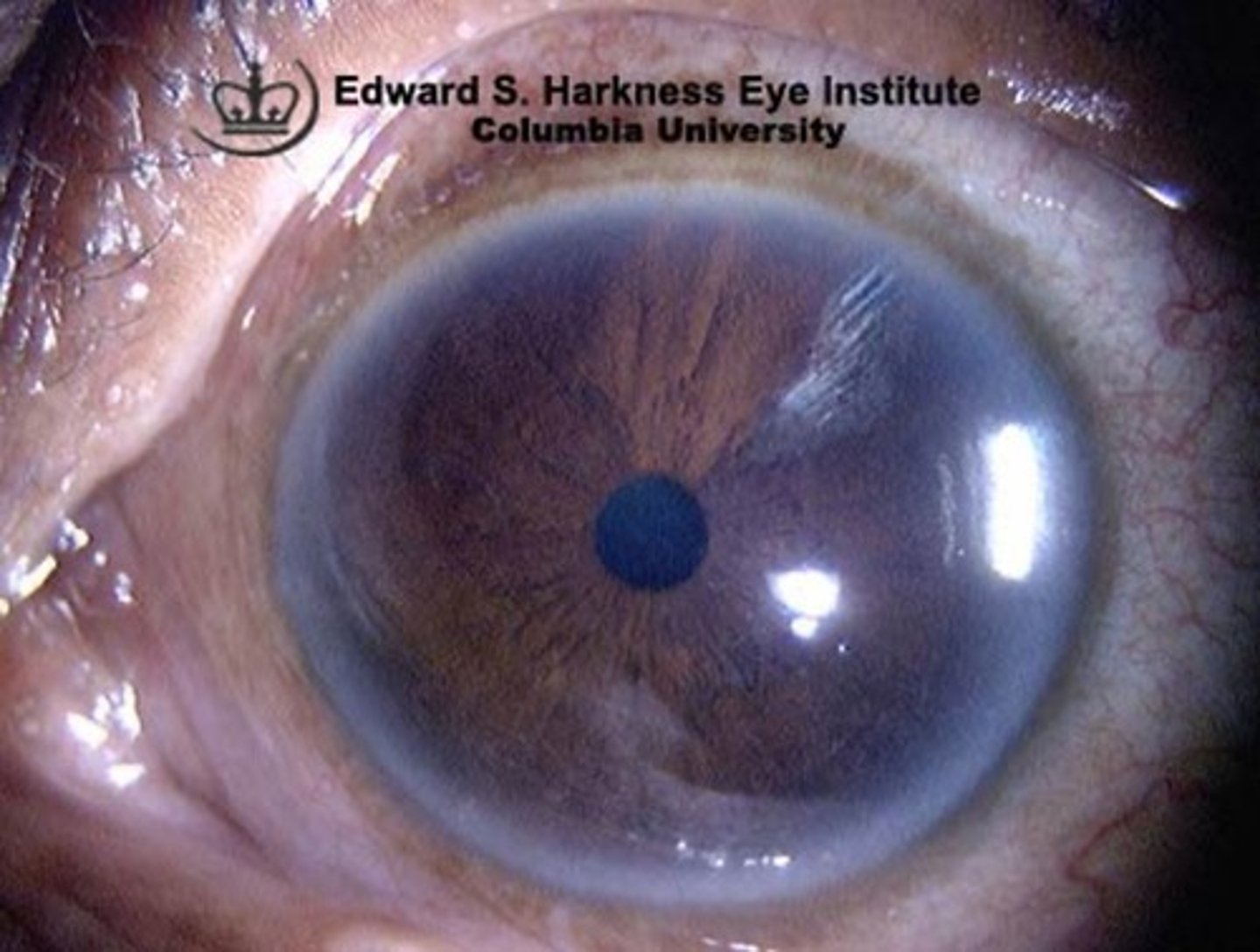<p>a white ring around the eye that can be seen in elderly patients</p><p>- if not due to age then could be due to calcium and severe triglyceride elevations (rare)</p>