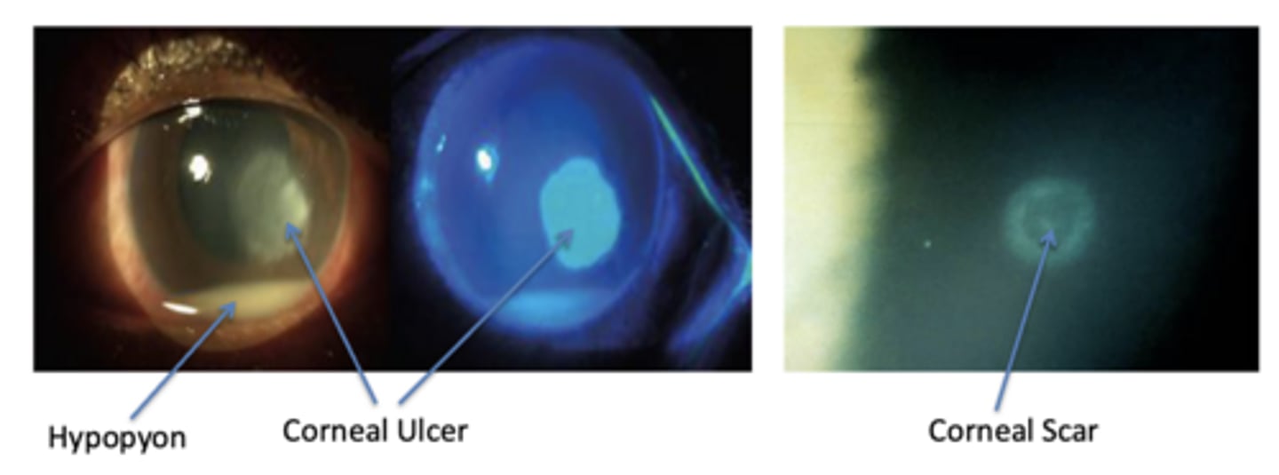 <p>What does a corneal ulcer look like?</p>