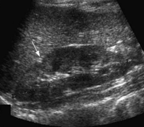 <p>What is the arrow pointing to? A small hyperechoic triangle</p>