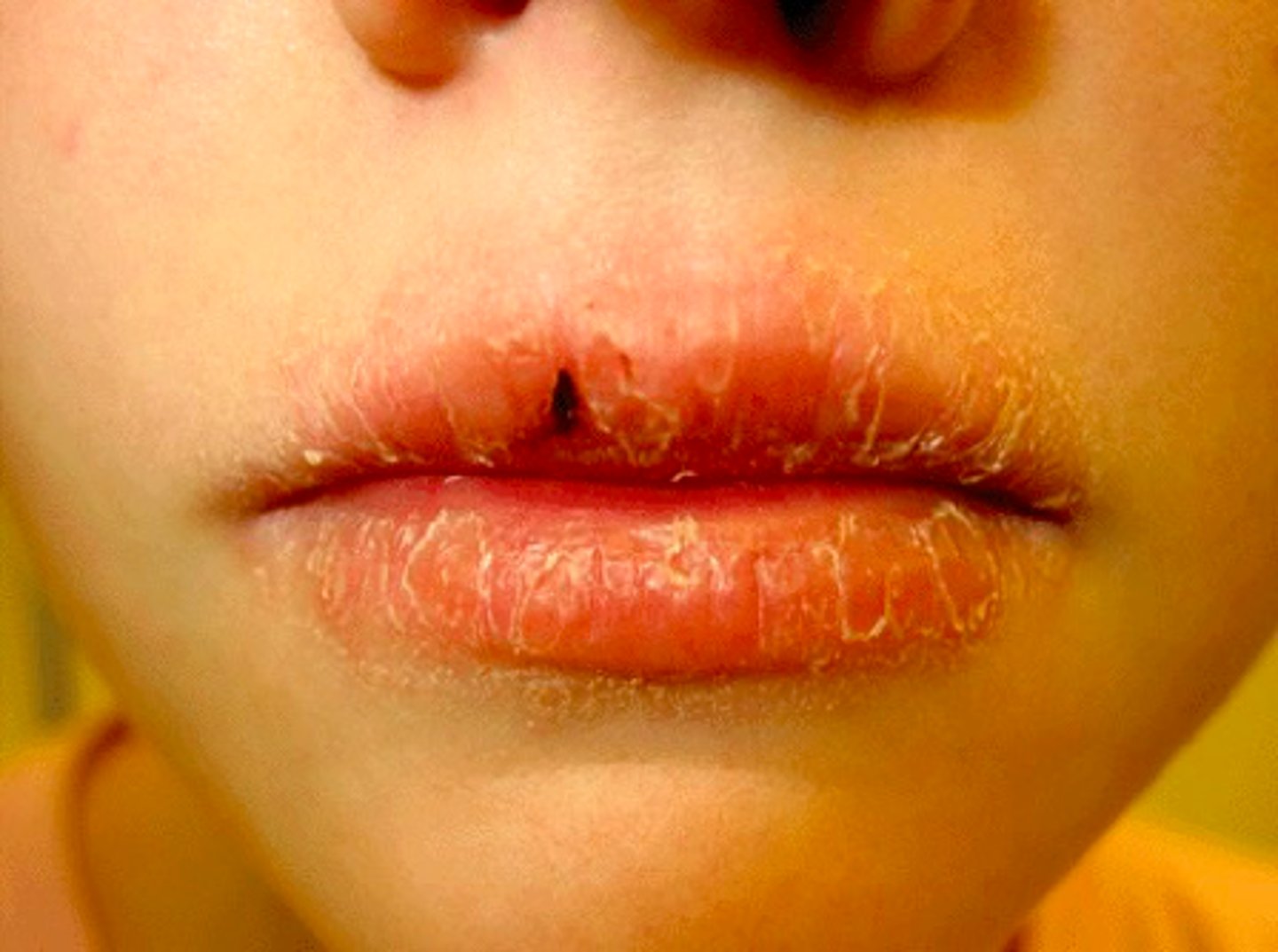 <p>patient presents with the following. They claim that they just tried new lip balm. Only the cutaneous and vermillion part of the are effected. What is the diagnosis?</p>