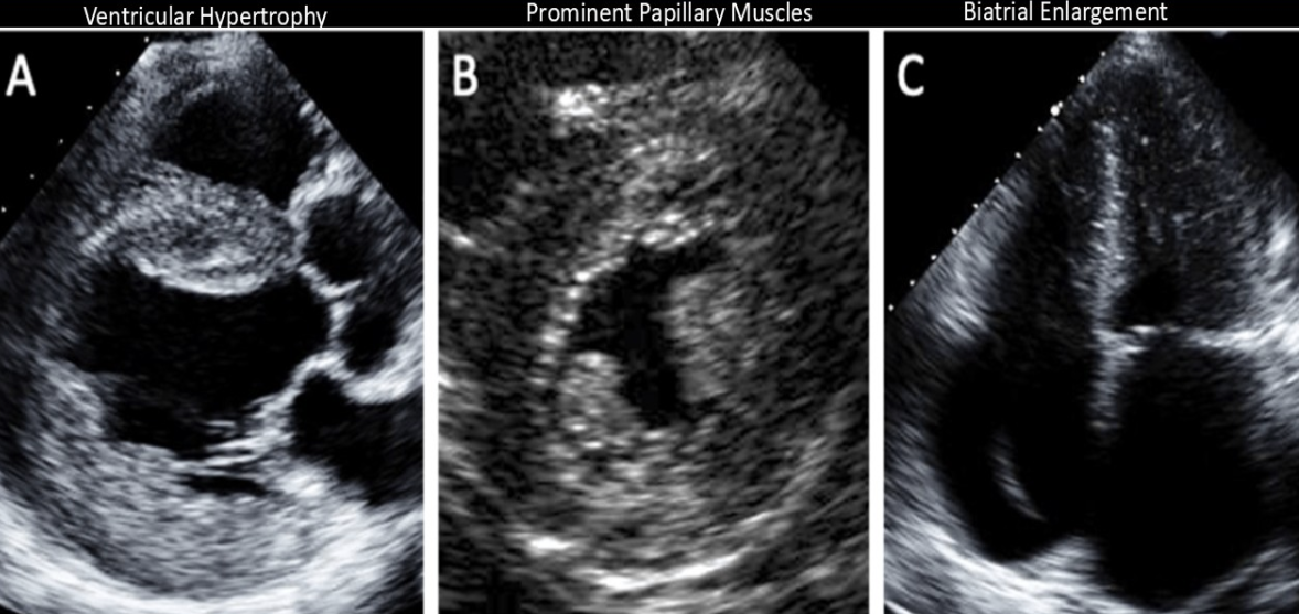 <ol><li><p>LVH</p></li><li><p>Prominent papillary muscles </p></li><li><p>Hyperechoic endocardial layer </p></li><li><p>Conduction defects </p></li></ol><p></p>