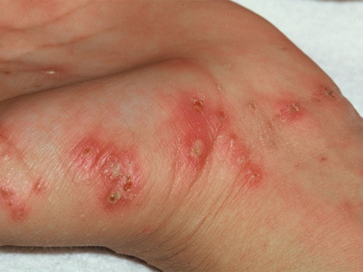 <p><b>Primary skin lesion</b><br><br>A minute, slightly raised tunnel in the epidermis, commonly found on the finger webs and on the sides of the fingers - short lineal or curved line and may end in a tiny vesicle<br><br>example: scabies (magnifying lens can identify the burrow of the mite that causes scabies)</p>