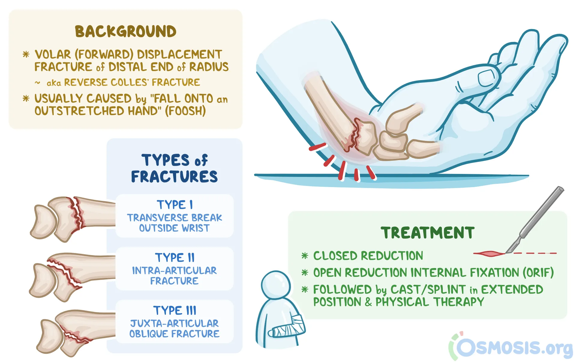 <p>volar displacement of radius (distal 2 cm transverse fracture)&nbsp;</p>