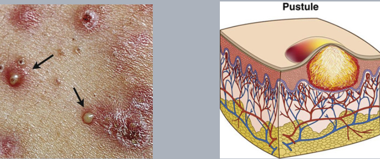 <p>pustule</p>