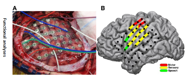 <p>EEG directly on the brain</p>