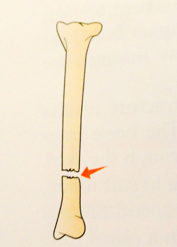 occurs straight across the bone