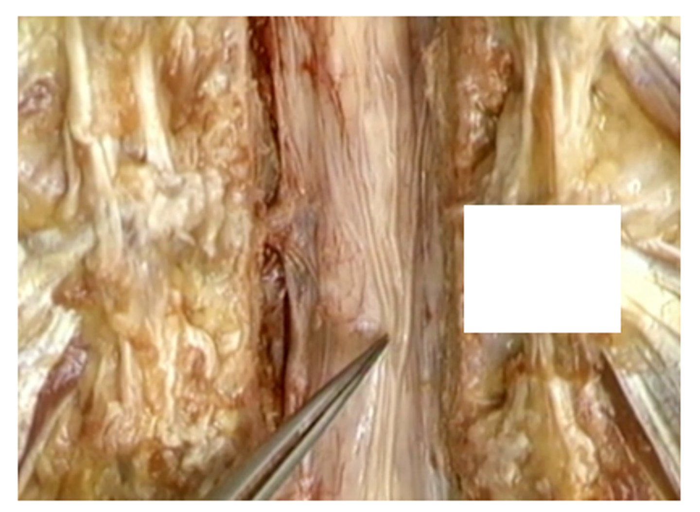 <p>Area where there is more pooling of CSF distal to the conus medullaris</p>