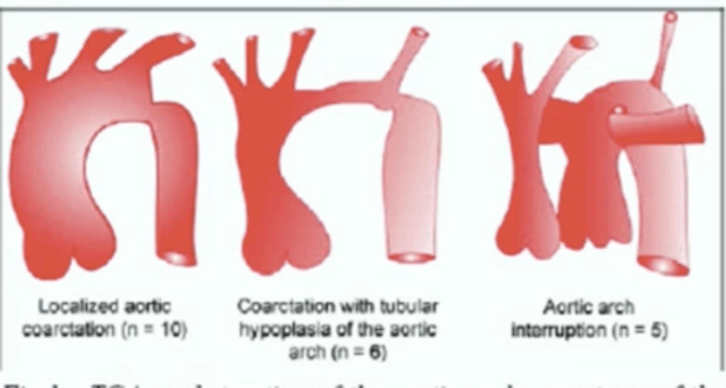 <p>Type A: distal to left subclavian artery</p><p>Type B: between left subclavian artery and left common carotid (MOST COMMON)</p><p>Type C: Between innominate and left common carotid (least common).</p><p>*Type B is commonly associated with abberant right subclavian and conoventricular VSD. Reconstruction of the abberant right subclavians not required.</p>