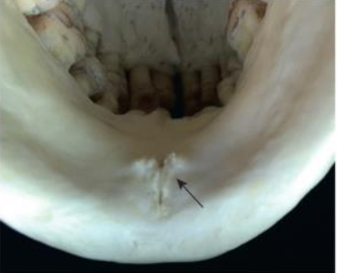 <p>Genial tubercles</p><ul><li><p>tiny bumps of bone on the lingual aspect of the mandible </p><ul><li><p><em>attachment site for genioglossus and geniohyoid muscles </em></p></li></ul></li><li><p>Radiography:<strong> ring-shaped radiopaque</strong> structure below the apices of the mandibular incisors </p></li></ul><p></p>