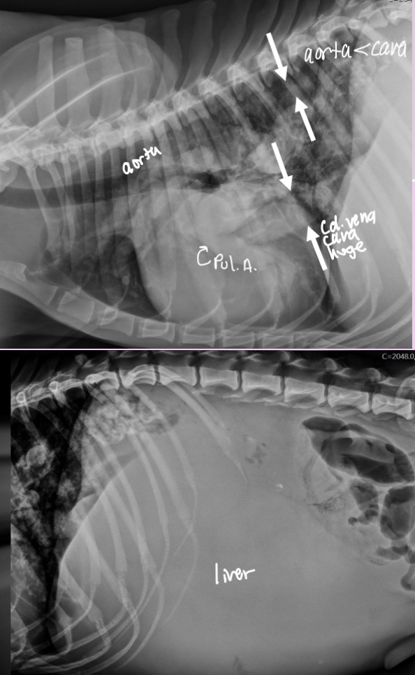 <p>-enlarged cd.VC(Venous congestion)</p><p>-hepatomegaly (visceral congestion)</p><p>-ascites</p>