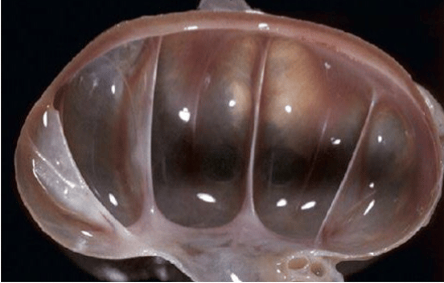 <p>Congenital malformation</p><p>Ureteral or urethral blockage</p><p>Neurogenic functional disorders</p><p>Iatrogenic</p>