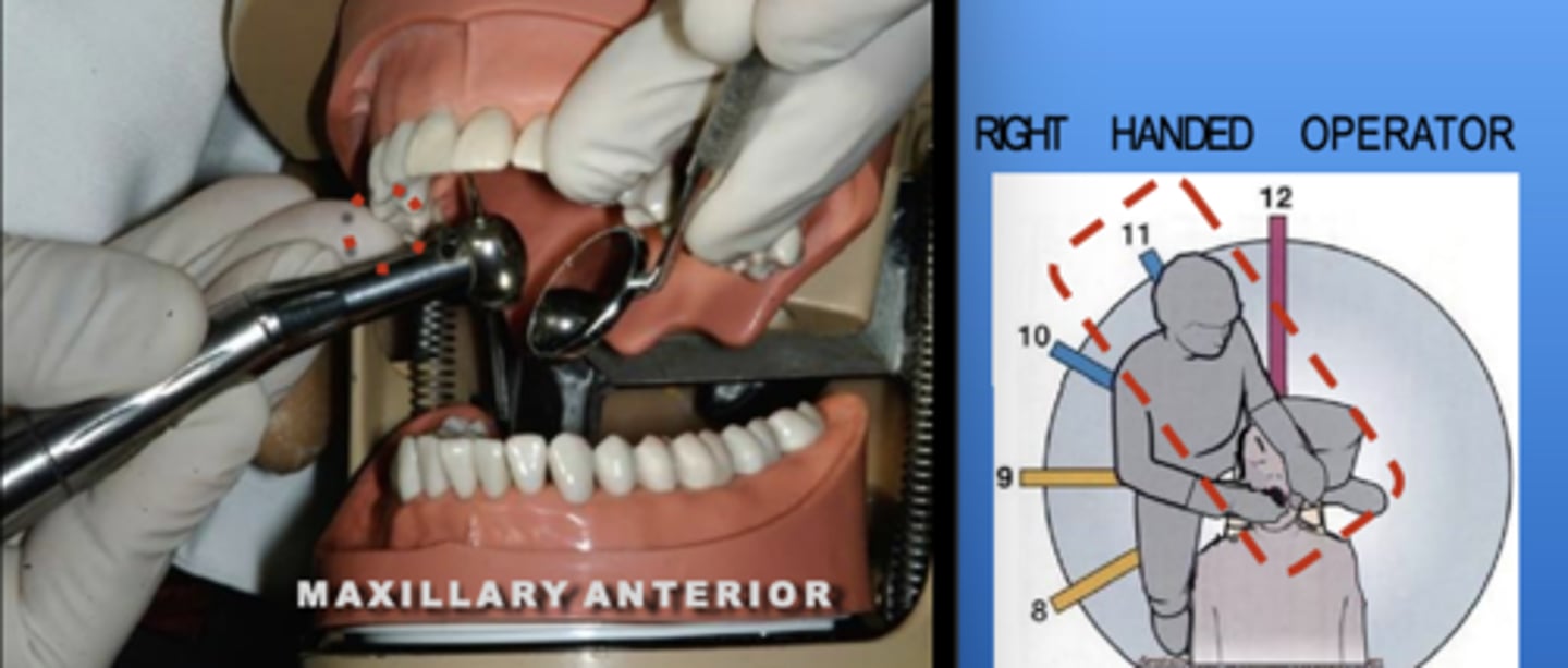 <p>Zone: 11</p><p>Vision: Indirect</p><p>Patient's Head: Center</p><p>Fulcrum: Max Right Premolars (O)</p>