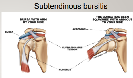 <p>subcutaneous bursa (patellar)</p><p>submuscular bursa (trochanteric)</p><p>subtendinous bursa (subacromial)</p>