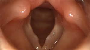<p>vocal fold nodules</p>