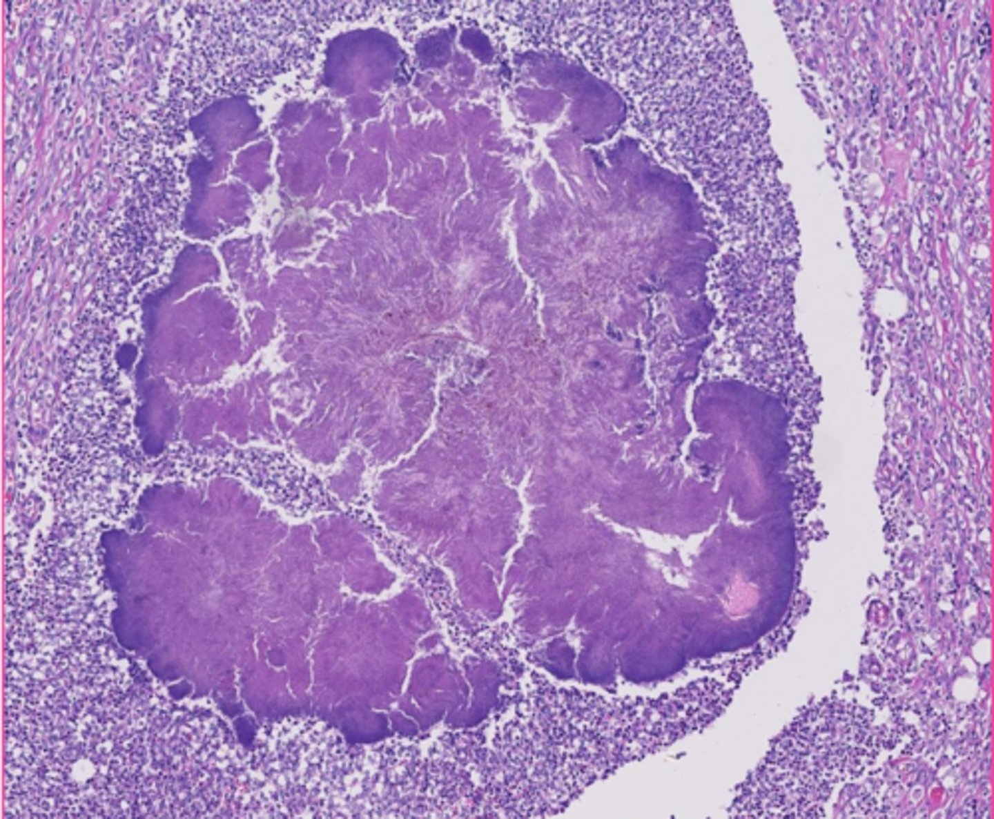 <p>this is actually a caseous necrosis, but how would you describe the extracellular inclusions?</p>