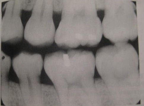 <p>Used to examine the inter-proximal surfaces of teeth</p>