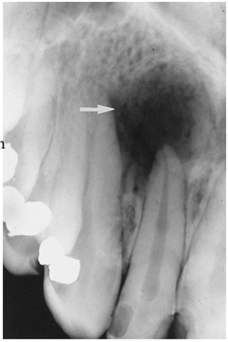 <p>radiolucency with one compartment</p>