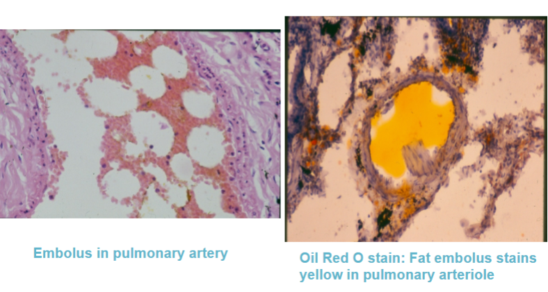 <p>Fat globules enter the bloodstream through tissue (usually bone marrow or adipose tissue) that has been disrupted by trauma </p><p>Occurs after fractures of long bones, e.g. femur.</p>