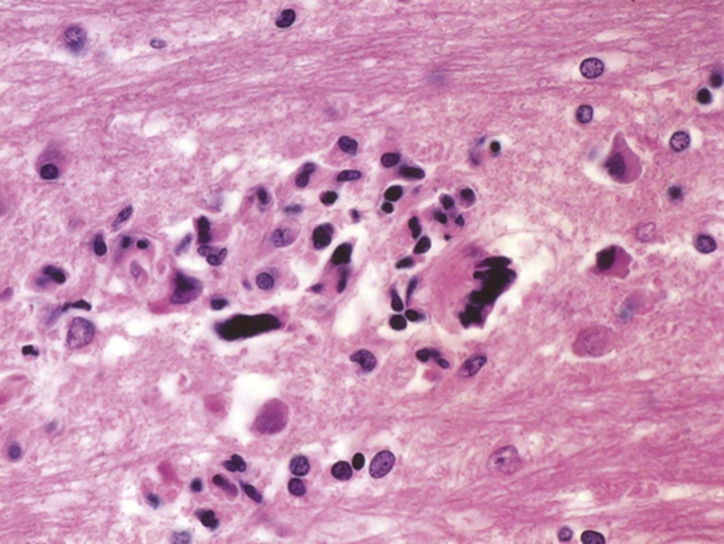<p>Define Virus:</p><p>Viral Infection of meninges</p><p>Info:</p><p>-Microglial Encephalitis (microglial nodules w/ multinucleated macrophages)</p><p>-Will live in HISTIOCYTES</p><p>-Immune reconstitution inflammatory syndrome</p>