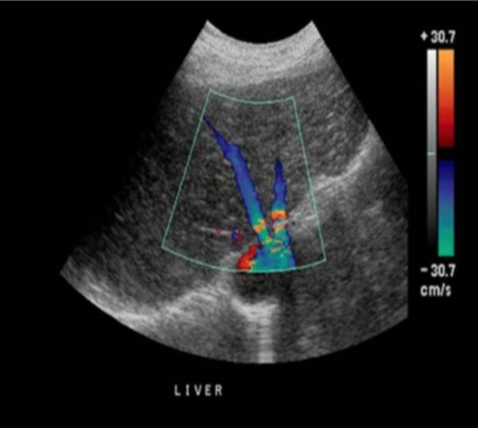<p>Which of the following describes the best way to eliminate the color Doppler aliasing in the proximal hepatic veins while maintaining proper flow display in the distal hepatic veins?</p><p>a. increase the color velocity scale to 0.60m/s<br>b. increase the color velocity scale to 0.40m/s<br>c. invert the door baseline <br>d. decrease the color priority</p>