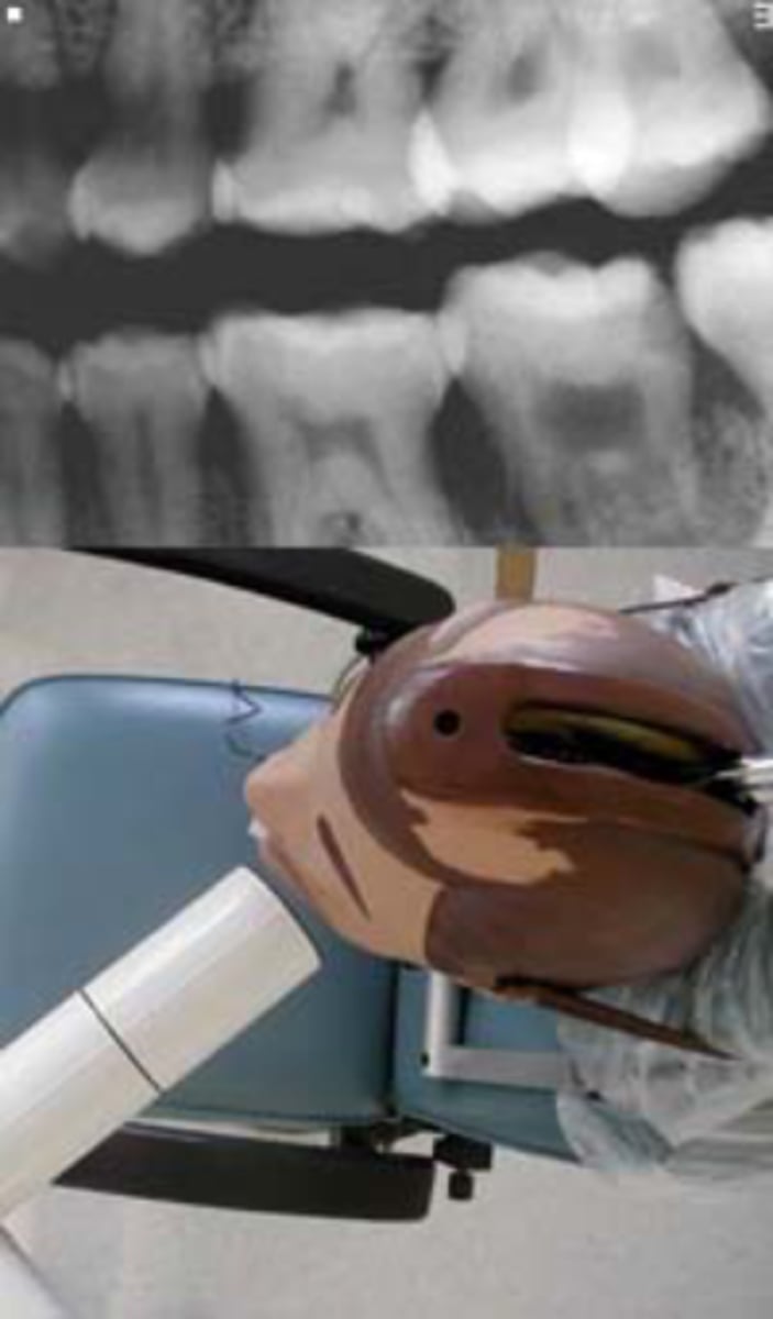 <p>-The x-ray beam is directed obliquely from mesial to distal</p><p>Cause - If overlapping is more severe in the posterior region, cone is angled too much form the mesial.</p><p>Correction - Shift the PID toward the posterior or direct the CR more from the distal</p>