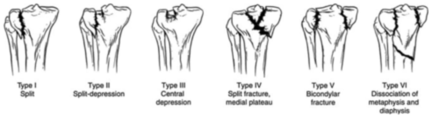 <p>6 types<br>1: wedge/split of lateral aspect of plateau<br>2: lateral wedge or split fx<br>3: pure compression fx lateral plateau<br>4: involves medial plateau<br>5: split fx of both condyles<br>6: complete bicondylar fx</p>