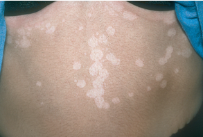 <ul><li><p><strong>Fungal Infection</strong>:</p><ul><li><p>Presents as hypopigmented lesions on the upper body.</p></li><li><p>Superficial tan or hypopigmented oval scaly lesions, especially on the upper back, chest, and proximal arms.</p></li></ul></li></ul><p></p>