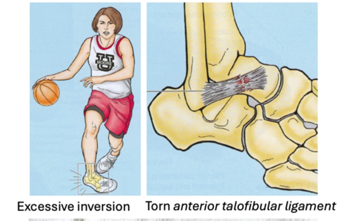 <p>-stretching or tearing of ligament(s)</p><p>-Inversion injuries more common (~80%)</p><p>-Anterior talofibular ligament: most commonly injured ligament, usually due to inversion injuries</p><p>-Eversion injuries less common = damage to the deltoid ligaments</p>