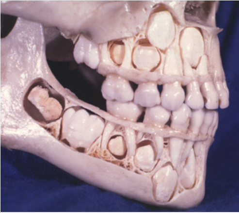 <p><strong><span style="font-family: Times New Roman, serif">Permanent Premolars and Second Molars form between years 2 &amp; 3.</span></strong></p><p><strong><span style="font-family: Times New Roman, serif">Root development: 2 ~ 4 years</span></strong></p>