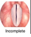 <p>not touching along entire length including vocal processes</p>