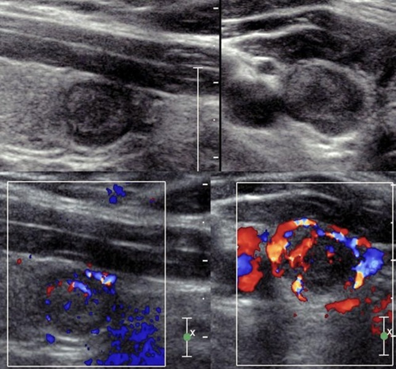 <p>Most common thyroid malignancy</p><p>Least aggressive type</p>