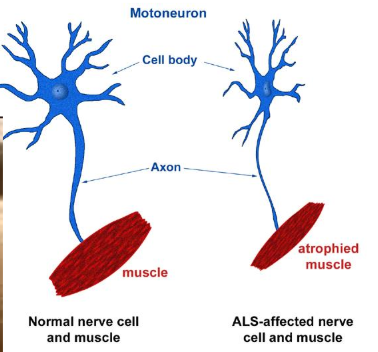 <p>aka Lou Gehrig disease</p><p>degeneration of motorneurons and consequent loss of their target muscles</p>
