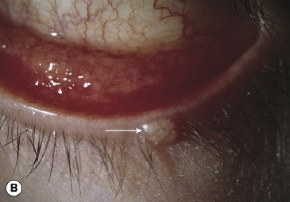 <p>Most commonly affects children between 2–4 years of age. Molluscum lesions are typically seen along the eyelid margin.&nbsp;</p>
