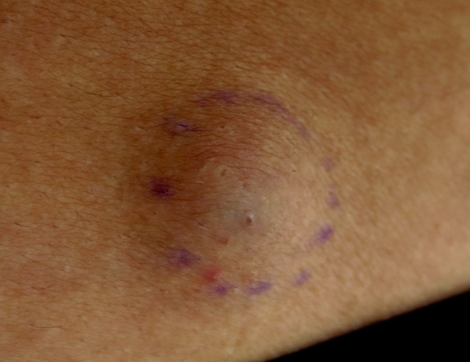 <p>2 month history of bump in lower back, same bump 6 month ago resolved spontaneous in 3 weeks. no pruitus,’, pain, other symptoms. </p><p>firm, mobile nodule, no drainage from lesion or tenderness to palpation. does not change shape when pressed. Dx?</p>