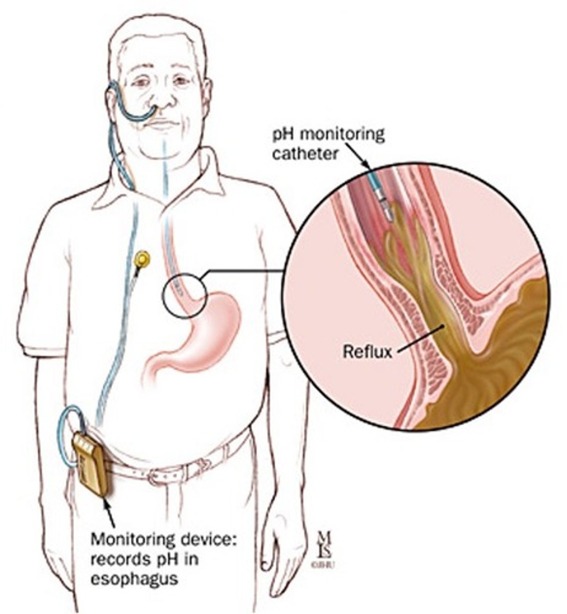 <p>ambulatory pH monitoring</p><p>- monitoring device inserted in esophagus, if pH drops then reflux is occuring</p><p>-costly; used for pts with atypical sx</p>