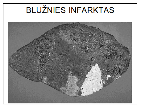 <p>dažniausiai yra aneminis, kartais hemoraginis. Jį paprastai s<strong>ukelia blužnies arterijos embolai.</strong></p>