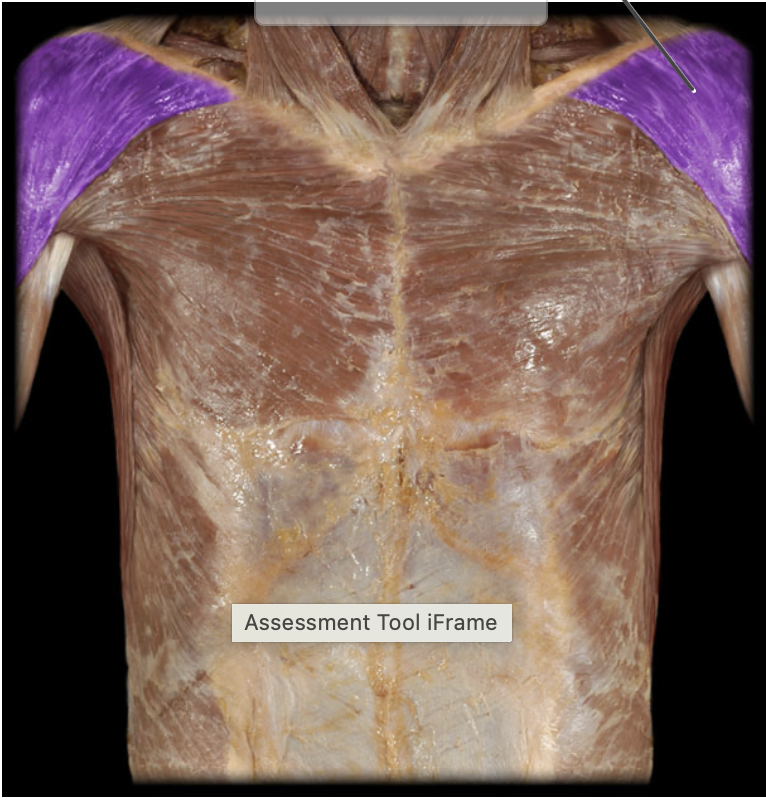 <p>Insertion of Deltoid</p>