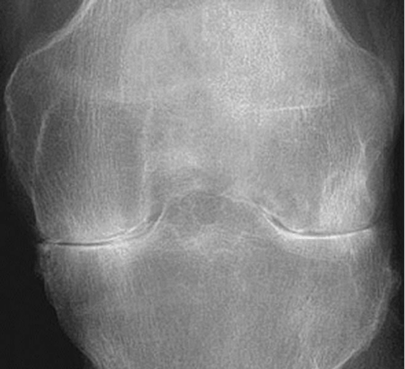 <p>ID type of arthritis</p>