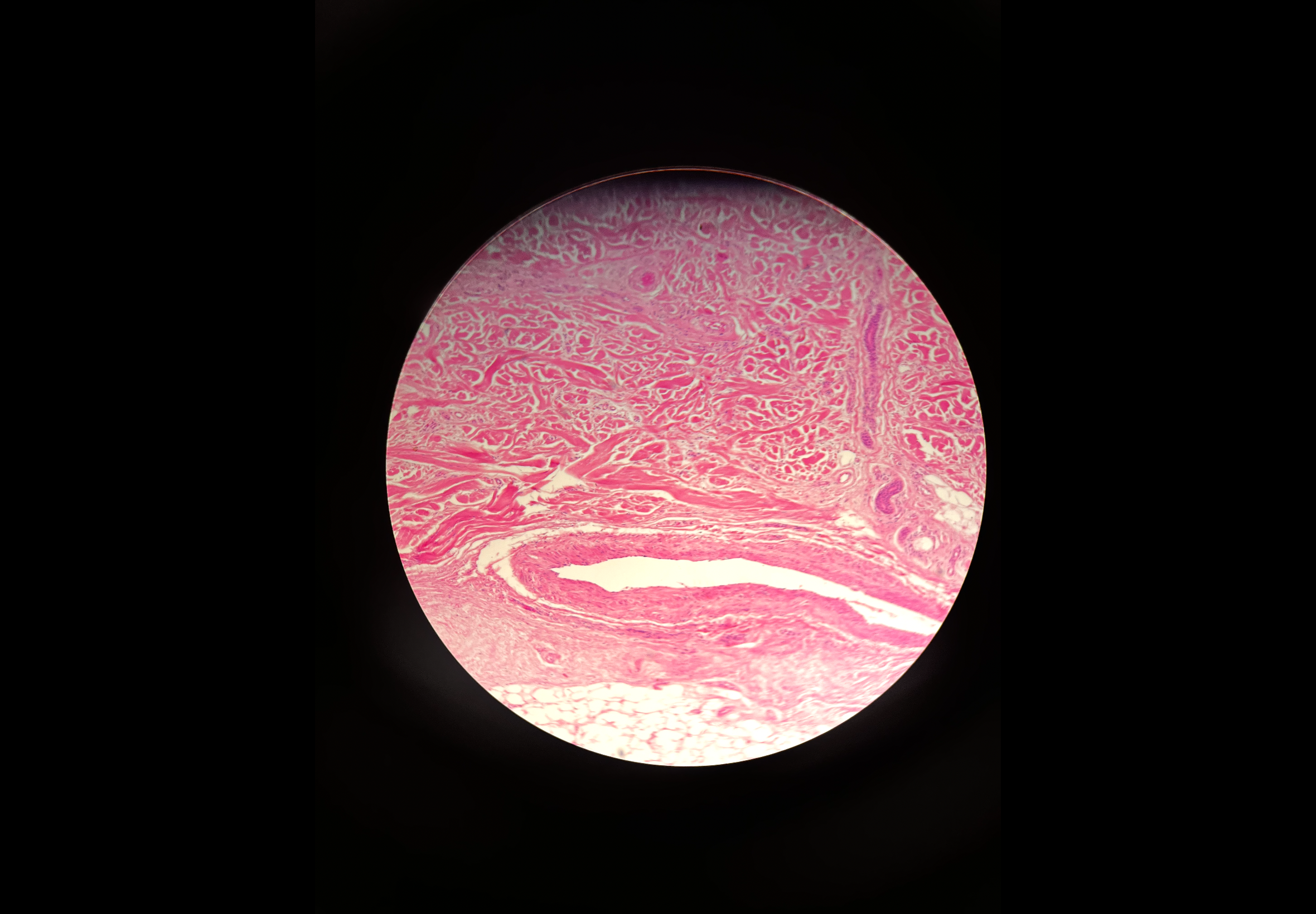 <p>Body location: dermis </p>