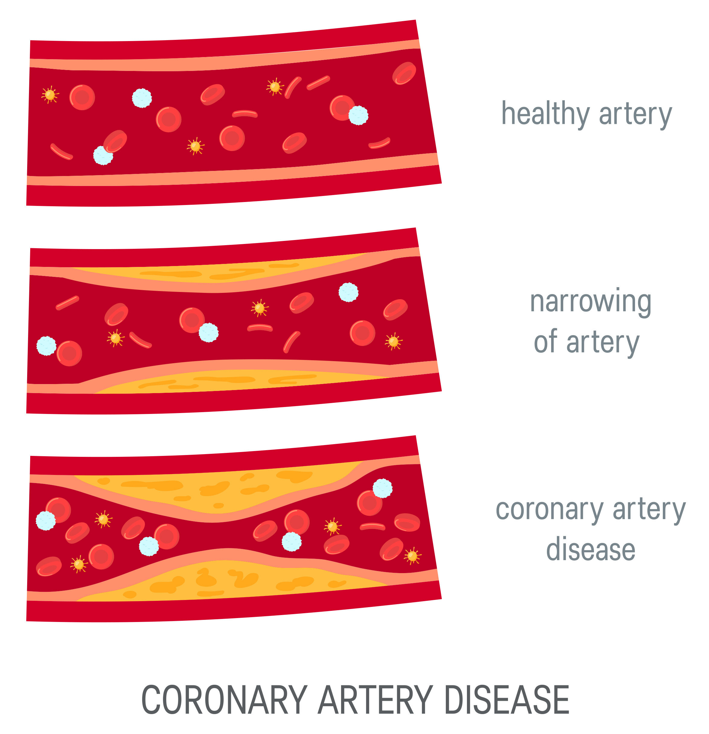 <p>A heart attack is caused when the blood supply to the heart stops. <br><br>1. Substances from tobacco smoke <strong><span style="color: yellow">DAMAGE</span></strong> the <strong><span style="color: yellow">ARTERY LINING</span></strong><br><br>2. <strong><span style="color: yellow">FAT BUILDS UP</span></strong> in the artery <strong><span style="color: yellow">WALL</span></strong> at the site of damage, making the artery <strong><span style="color: yellow">NARROWER</span></strong><br><br>3. A blood clot may <strong><span style="color: yellow">BLOCK</span></strong> the artery or <strong><span style="color: yellow">BREAK OFF</span></strong> and block another artery in the body - <strong><span style="color: yellow">HEART ATTACK</span></strong></p>