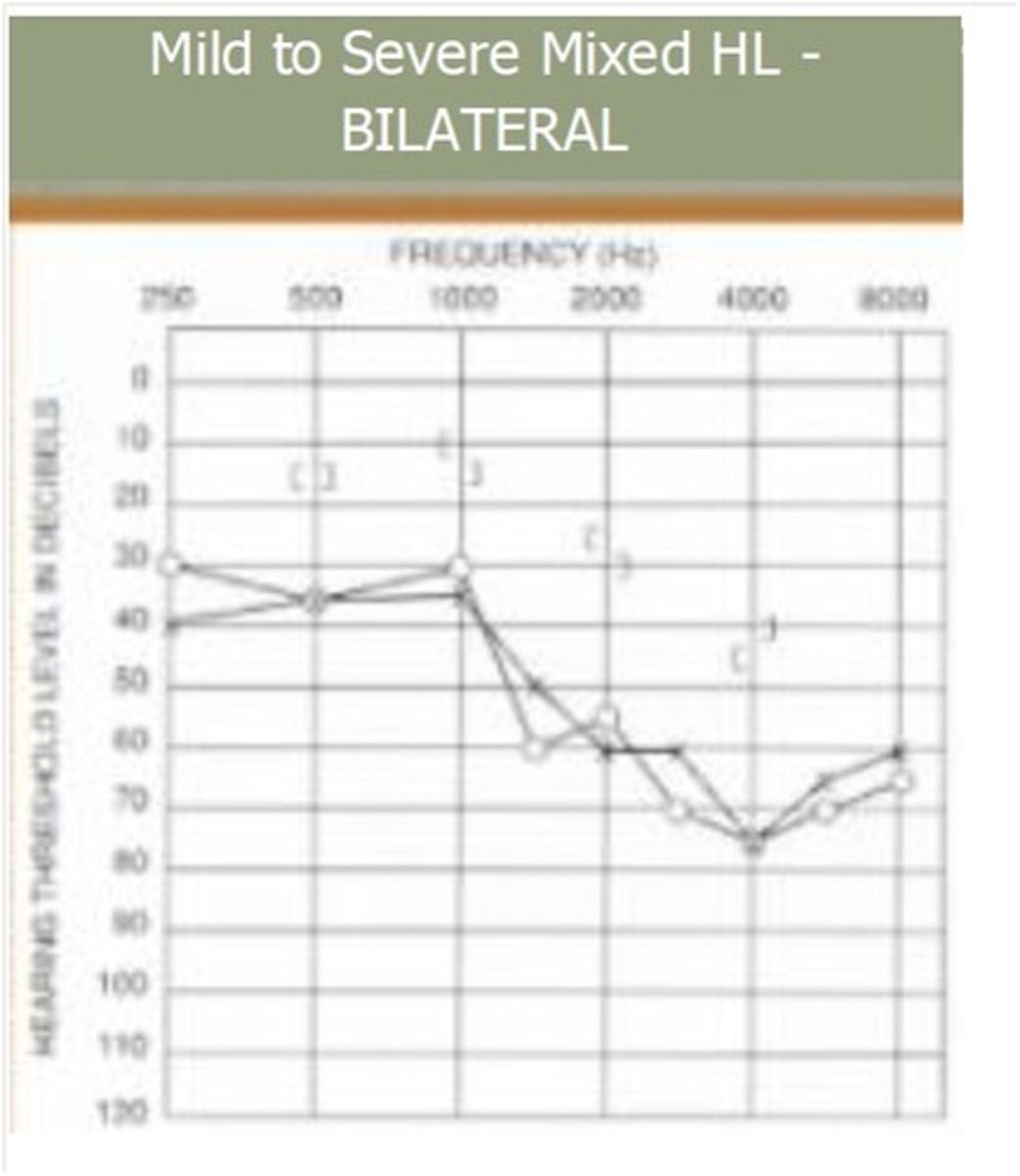 <p>A graphic representation of the relation of vibration frequency and the minimum sound intensity for hearing<br>Normal at very top</p>