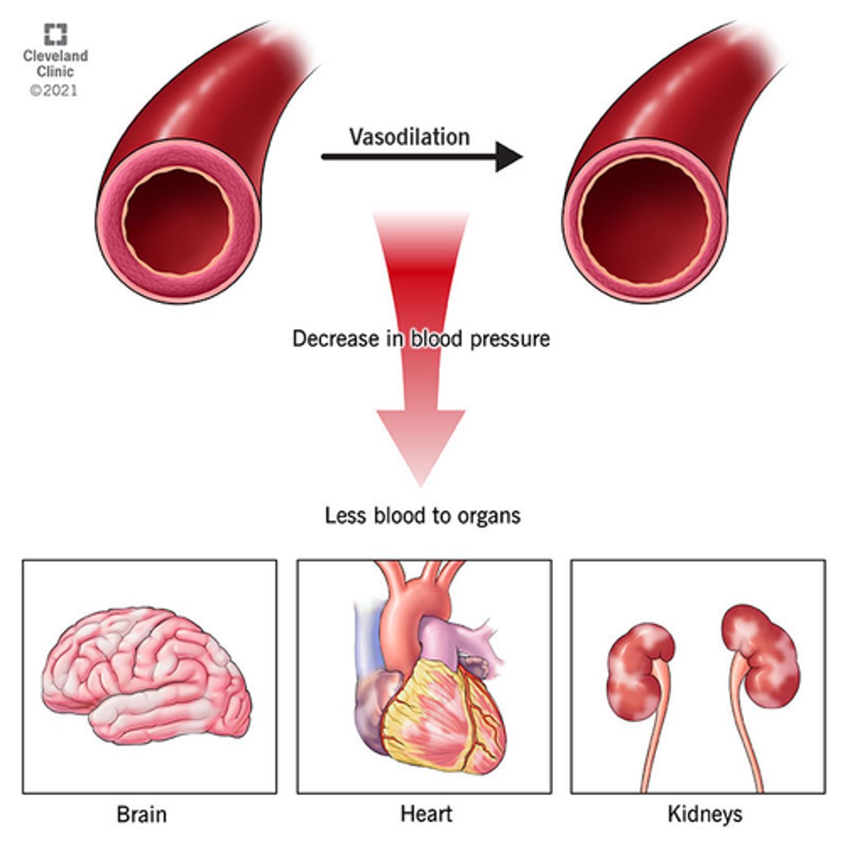 <p>- overwhelming inflammatory response</p><p>- vasodilation => low volume for the size of the circulatory compartment => fluid shift</p><p>- aka 'vasodilatory shock', 'normovolemic shock'</p><p>- loss of blood vessel tone &amp; enlargement of vessel lumen - insufficient BP for perfusion</p><p>- no absolute loss of blood BUT redistributed via vessel permeability, therefore low</p><p>vascular volume</p>