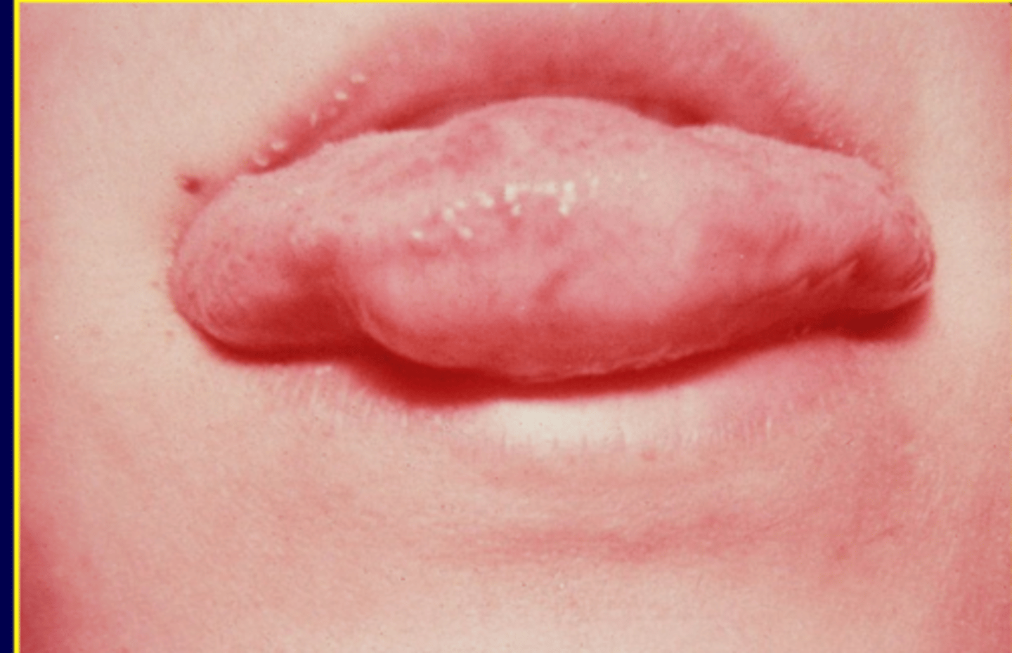 <p>AKA Schwannoma </p><p>• soft, painless, well-defined nodule</p><p>• less than 3cm</p><p>• common location: tongue </p>