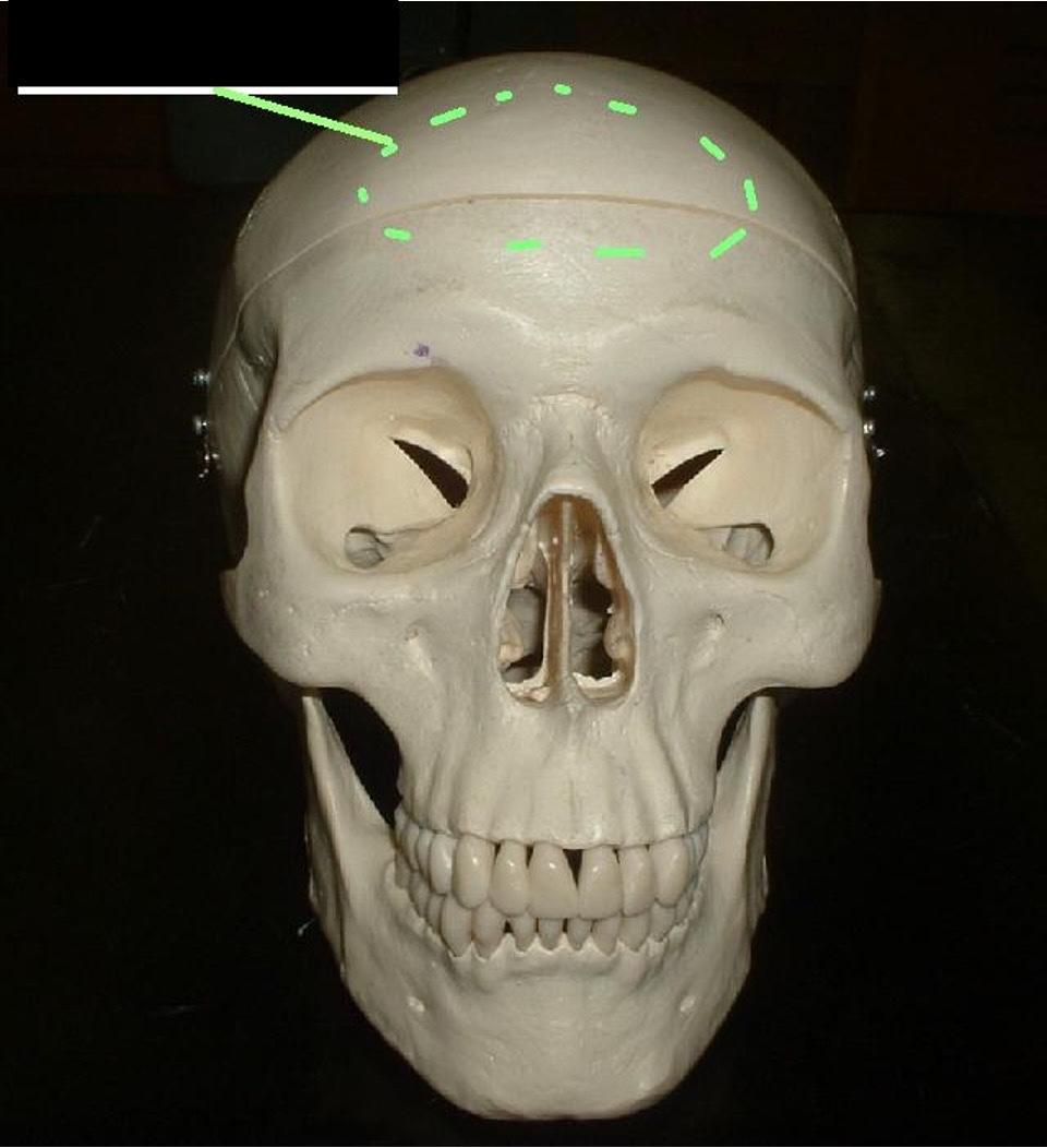 <p>middle, front, flat part of the frontal bone</p>