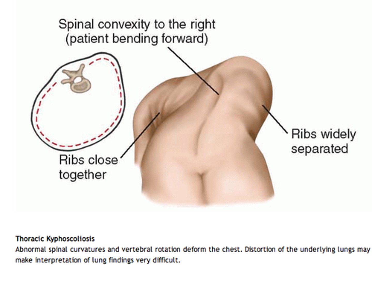 <p>D. Thoracic kyphoscoliosis</p>
