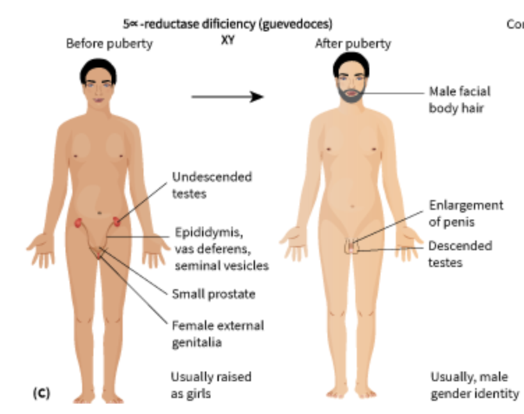 <p><span>affects sexual development before birth and during puberty in people with XY (typically male) chromosomes. </span>Usually appears/born like a girl in childhood but develops <strong>male secondary characteristics</strong> during puberty. <span>Deficiency in a hormone called&nbsp;<strong>dihydrotestosterone.&nbsp;</strong>Most are also <strong><em>infertile.&nbsp;</em></strong></span></p>