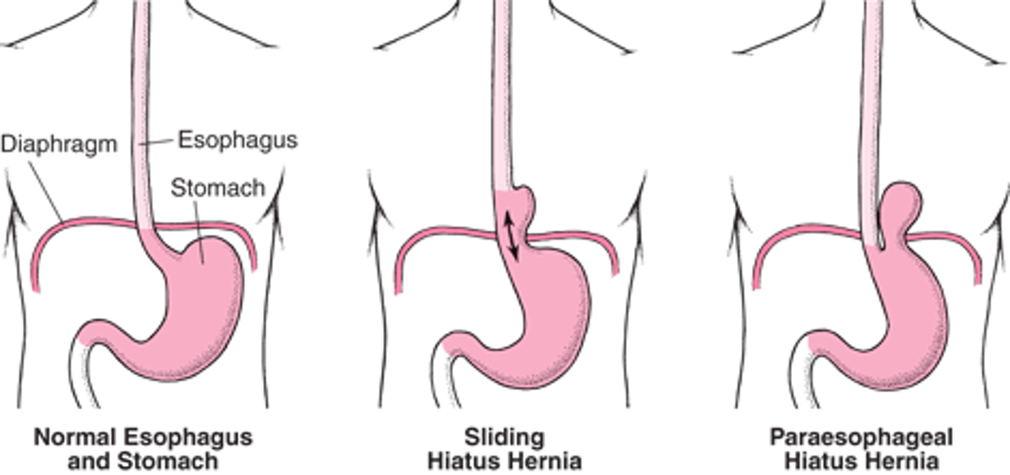 <p>EPI</p><p>- age over 50 due to weaken structures</p><p>- sliding is 95% and rolling 5%</p><p>- Barrett's esophagus is prone due to continued erosion of the esophagus from GERD</p><p>PATHO</p><p>- portion of the stomach protrudes upward through esophageal hiatus (opening) and can prevent proper closure</p><p>- type 1 is sliding</p><p>- type 2 is rolling</p><p>DX</p><p>- barium swallowing with fluoroscopy (most specific)</p><p>-Esophagogastroduodenoscopy/EGD to views the esophagus and stomach lining</p><p>- upper abdominal x-ray</p><p>- endoscopy</p><p>MEDICATIONS</p><p>- tx symptoms of heartburn and reflux</p><p>- antacids like tums, maalox, and mylanta</p><p>- PPI like Protonix/pantoprazole and Prilosec/omeprazole</p><p>- H2 receptor antagonists: pepcid/famotidine and Zantac/ranitidine</p><p>- Prokinetic agents: Reglan/metoclopramide to mobilize gut</p><p>SURGICAL</p><p>- Nissen fundoplication type 2</p><p>- hernia repair that will move it back in place and put mesh lining on top</p><p>COMPLICATIONS</p><p>- GERD/heartburn</p><p>- supradiaphragmatic volvulus: strangulation of hernia causing blood cut off</p><p>- intussusception: part of intestine is blocked and goes into itself</p><p>ASSESSMENT</p><p>- dysphagia</p><p>- GERD/heartburn</p><p>- n/v</p><p>- iron anemia</p><p>- symptoms worsen after eating</p><p>- regurgitation</p><p>- eructation/belching</p><p>- feeling of suffocation/SOB</p><p>- chest pain</p><p>ACTION</p><p>- position pt supine on the right side</p><p>- HOB above 30 after meals</p><p>- antacids to neutralize stomach acids</p><p>- histamines and PPI to reduce acid production</p><p>- prokinetics to increase gastric emptying</p><p>TEACHING</p><p>- limit foods like spicy/fatty, caffeine, chocolate, carbonated, acidic, peppermint, alcohol, and certain meds</p><p>- eat meals 2 hours before lying supine</p><p>- wear nonrestrictive clothing</p><p>- maintain normal weight</p><p>- proper positioning after eating</p><p>- when to seek medical care ie cardiac symptoms</p><p>- postoperative education</p>