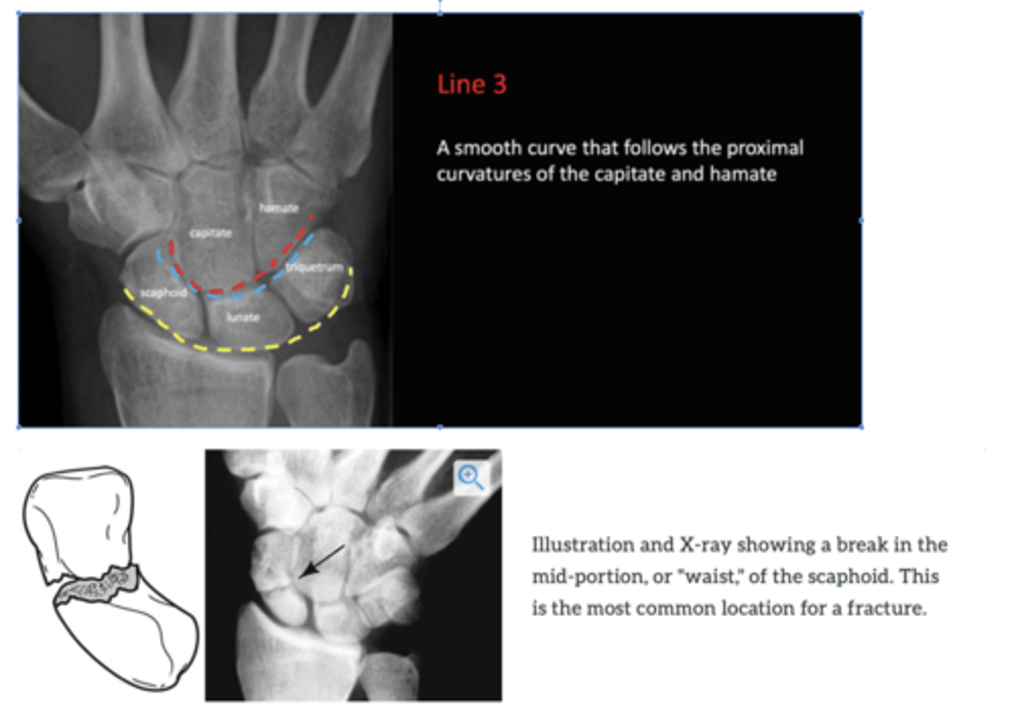 <p>The lines of force during movement pass through the scaphoid bone due to its position relative to Gilula's arcs II and III, making it the most commonly fractured carpal bone.</p>
